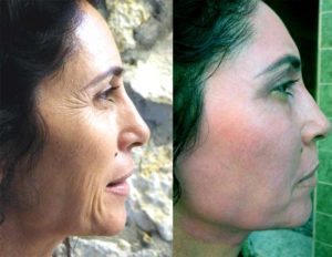 Besthetics A Műtét nélküli arc, nyak es szemhéj plasztika